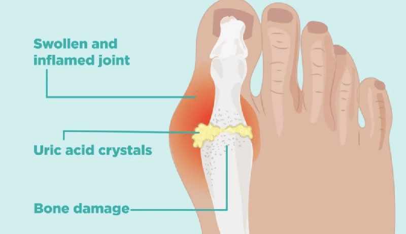 The End of Gout Review